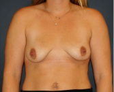Feel Beautiful - Breast Augmentation Lift 58 - Before Photo